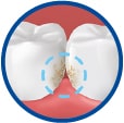placca nelle superfici interdentali tra dente e dente con cerchio tratteggiato