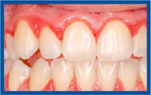 Come Prevenire E Curare La Gengivite | Kena Clinics - Foto 2