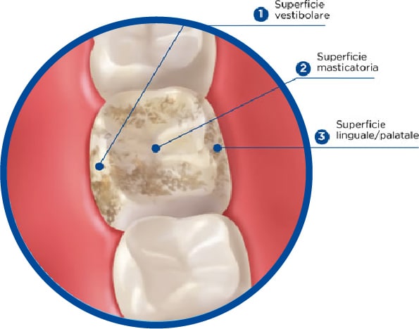 le 3 superfici del dente: vestibolare, masticatoria, linguale/palatale
