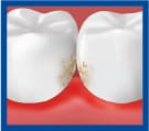 placca nelle superfici interdentali tra dente e dente