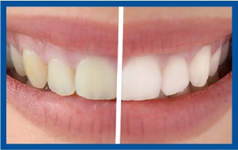 sbiancamento dentale confronto prima/dopo