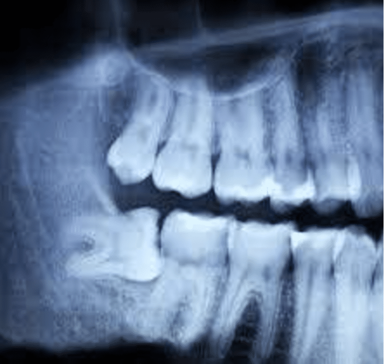 foto radiografia dei denti del giudizio