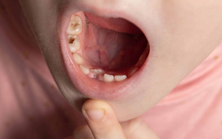 foto bocca di un bambino con denti cariati