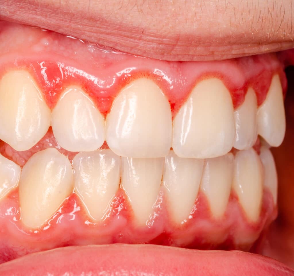 immagine della bocca con gengive infiammate di un paziente affetto da gengivite