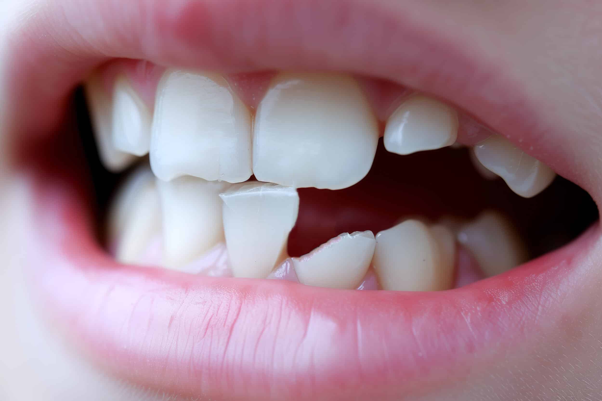 foto reale di una bocca con denti rotti